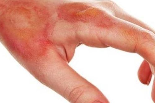 Thuốc trị nhiễm trùng da từ nhựa cây