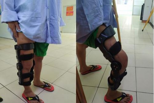 Tái ghép, cứu thành công đôi chân chiến sĩ trẻ bị ung thư