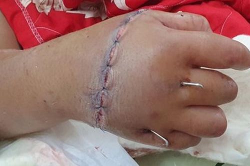 Nối thành công bàn tay cho bé trai 12 tuổi bị chém đứt rời