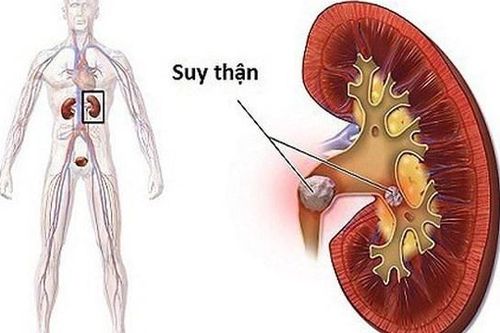 Tổn thương thận do đái tháo đường ngày càng tăng