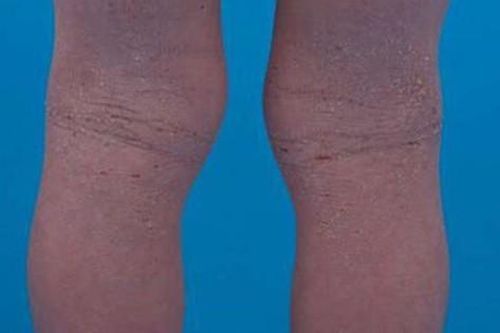Đã tìm ra thuốc điều trị bệnh chàm nặng ở trẻ