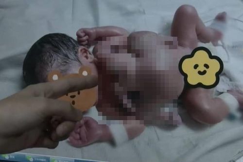 Bác sĩ Trung Quốc cứu bé trai 4 tay 4 chân bị bào thai ký sinh đeo bám