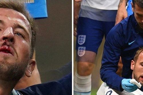 Kane chảy máu be bét nhưng ĐT Anh vẫn không có penalty