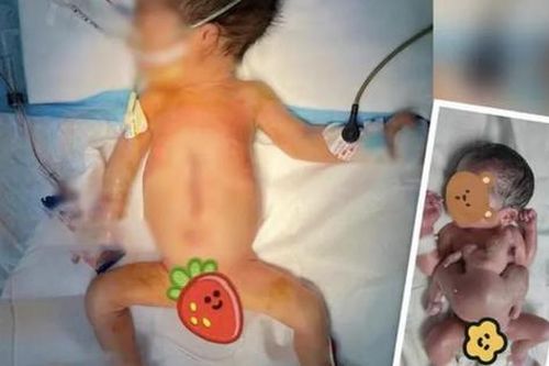 Sửng sốt bé trai sơ sinh có 4 tay 4 chân