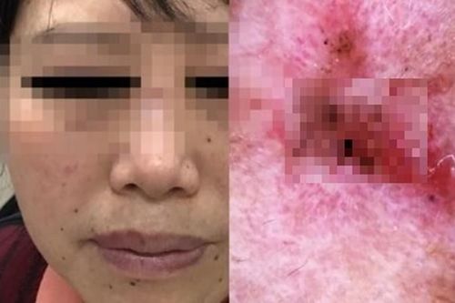 Đi khám da liễu, người phụ nữ phát hiện ung thư bởi điều này