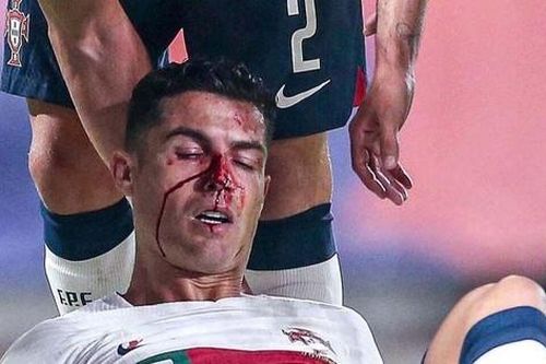 Ronaldo bê bết máu vì bị thủ môn đối phương đấm gãy mũi