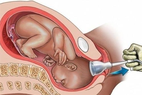 Rặn đẻ mãi không được nên phải sinh con bằng giác hút, mẹ lo sau này con gặp rủi ro