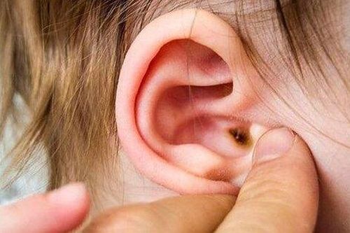Biến chứng đáng sợ của viêm tai giữa và cách phòng tránh từ chuyên gia