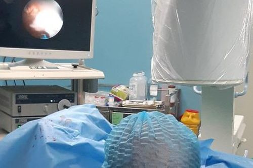 Bài toán khó-Phẫu thuật tán sỏi san hô Mini PCNL với tư thế nằm ngửa cải biên