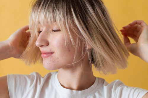 Cách để da sáng, giảm thâm dù đang trị mụn