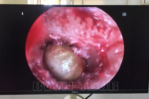 Phát hiện ve chó còn sống trong tai bé gái 2 tuổi