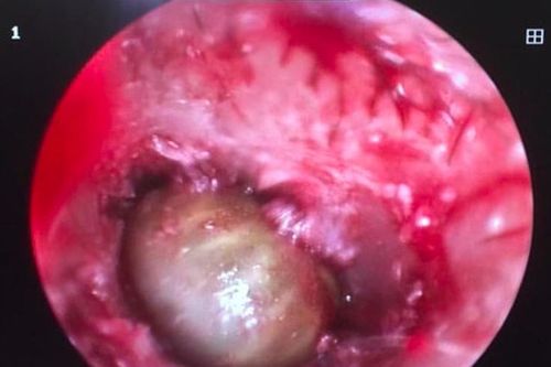 Ve chó sống khỏe trong tai bé gái 2 tuổi