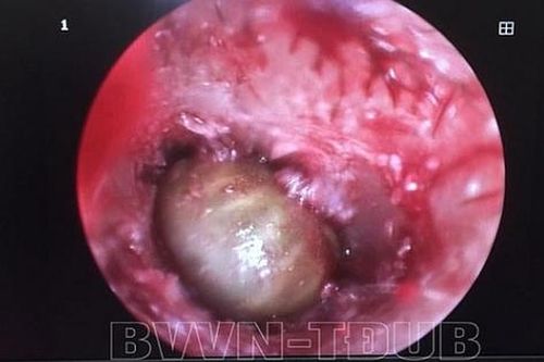 Cận cảnh bé gái bị ve chó chui vào làm tổ trong tai