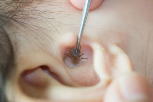 Thường xuyên thấy trẻ đau nhức tai, chảy dịch, đi khám mới tá hỏa phát hiện con vật kinh khủng bên trong