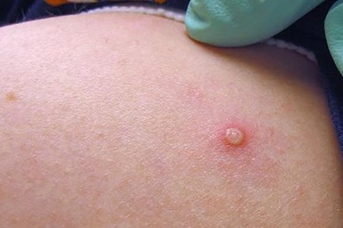 Bệnh đậu mùa khỉ lây truyền qua những đường nào?