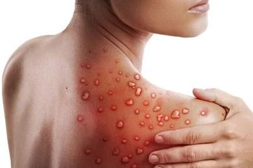 Thông tin về bệnh nhân đầu tiên mắc bệnh Đậu mùa khỉ tại Việt Nam