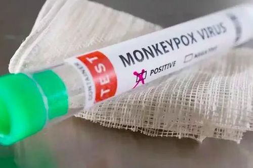 Bộ Y tế gửi văn bản khẩn sau khi phát hiện ca mắc bệnh đậu mùa khỉ