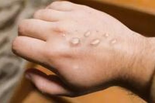 TP.HCM ghi nhận ca bệnh đậu mùa khỉ đầu tiên