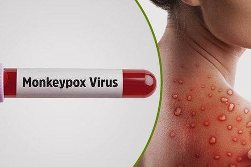Phòng ngừa bệnh đậu mùa khỉ đừng quên bảo vệ sức khỏe tình dục