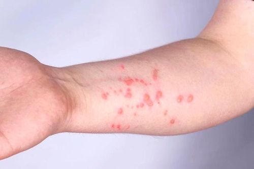 Thông tin sức khỏe của bệnh nhân mắc đậu mùa khỉ đầu tiên ở Việt Nam