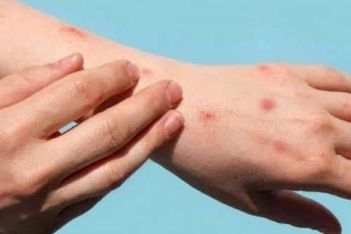 Bệnh nhân mắc đậu mùa khỉ tại TP. Hồ Chí Minh đã âm tính với virus