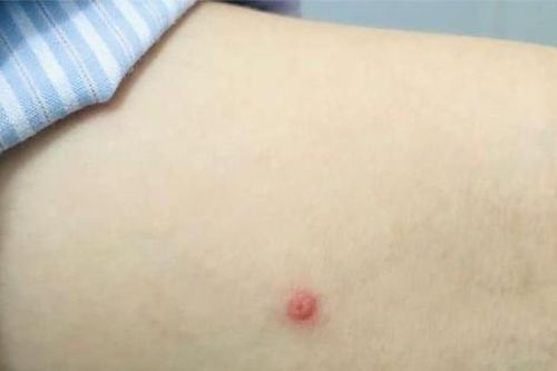 Sức khỏe ca bệnh đậu mùa khỉ đầu tiên ở Việt Nam ra sao?