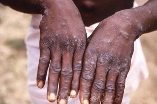 Việt Nam đã chuẩn bị từ rất sớm để đối phó với bệnh đậu mùa khỉ