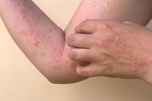 Bệnh nhân mắc đậu mùa khỉ đã có kết quả xét nghiệm âm tính