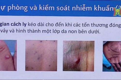 Việt Nam chủ động phòng chống dịch đậu mùa khỉ
