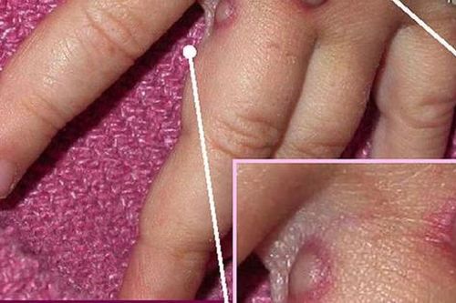 Phân biệt bệnh đậu mùa khỉ và thủy đậu