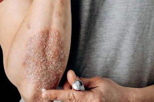 Cảnh báo tác dụng phụ của steroid tại chỗ trên da