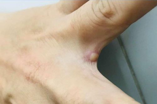 Đậu mùa khỉ có phải là bệnh lây truyền qua đường tình dục?