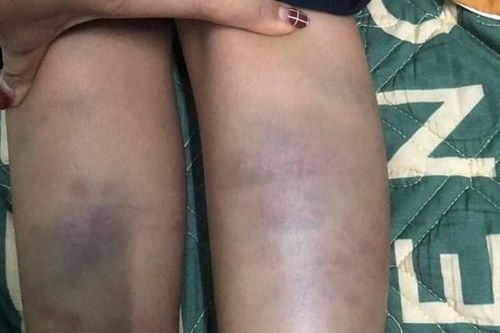 Đà Nẵng: Trẻ lớp 1 bị bầm tím tay chân, nghi do bạo hành