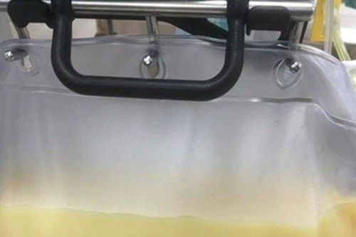 Người đàn ông có huyết tương trắng đục như sữa vì nghiện thức uống này