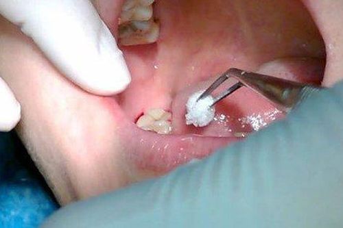Từ vụ cô gái 24 tuổi mất mạng vì nhổ 4 răng khôn, chuyên gia chỉ rõ trước khi quyết định cần biết điều này!