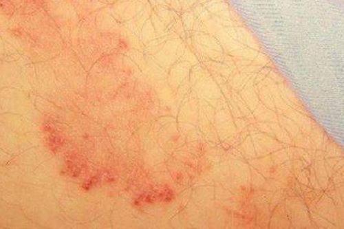 Nhiễm nấm vùng bẹn cần xử trí thế nào để hạn chế tái phát?
