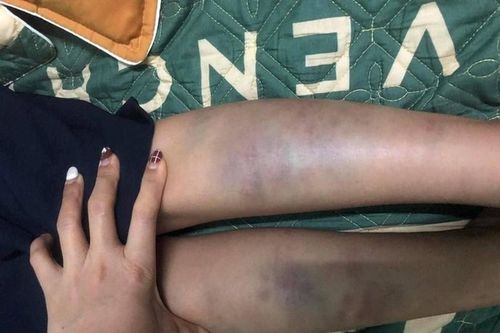 Đà Nẵng: Diễn biến mới vụ học sinh lớp 1 bị đánh bầm tím