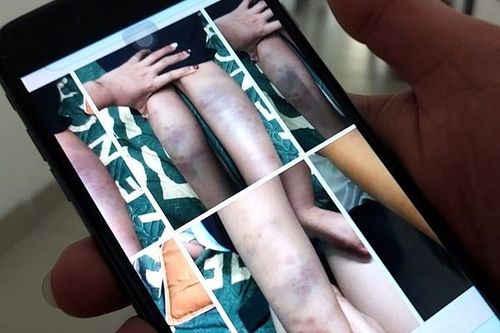 Vụ học sinh bị đánh bầm tím: Giáo viên chủ nhiệm tạm dừng đứng lớp để phối hợp điều tra