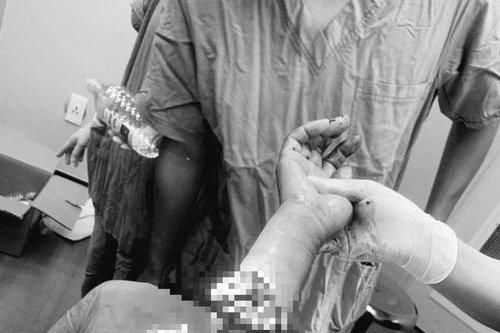 Nối cánh tay gần đứt lìa cho người phụ nữ bị cưa cắt