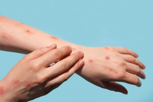 Người mắc HIV và nguy cơ khi nhiễm đậu mùa khỉ