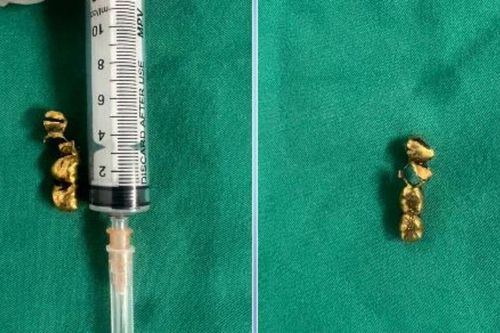 Đi làm răng, cụ ông 92 tuổi bị răng giả rơi vào phế quản