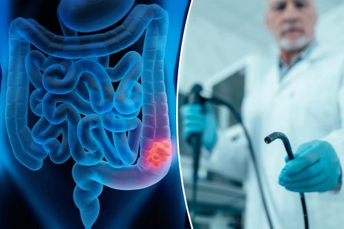Nội soi đại tràng có thể không hiệu quả như chúng ta nghĩ