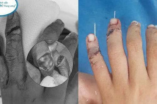 Phụ giúp anh nấu cơm, bé trai 7 tuổi suýt đứt rời ngón tay
