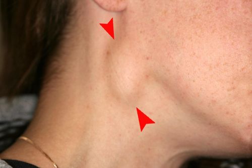 Triệu chứng không ngờ cảnh báo bệnh ung thư vòm mũi họng