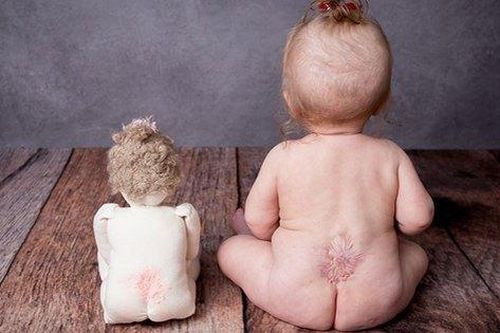 Liệu pháp tế bào gốc đầu tiên điều trị dị tật nứt đốt sống
