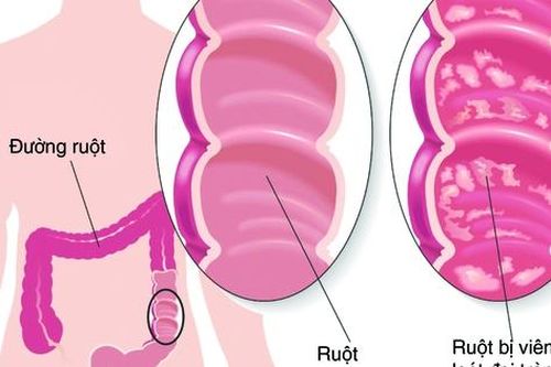 Liệu pháp kết hợp thuốc có thể giúp chữa viêm loét đại tràng hiệu quả