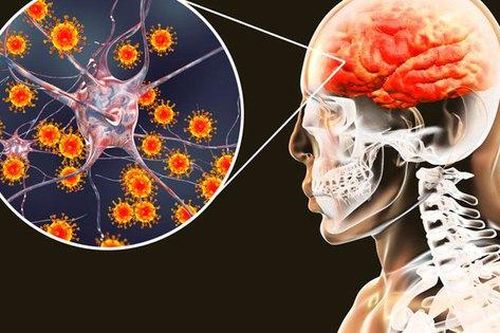 Cần cảnh giác với viêm não cấp ở trẻ