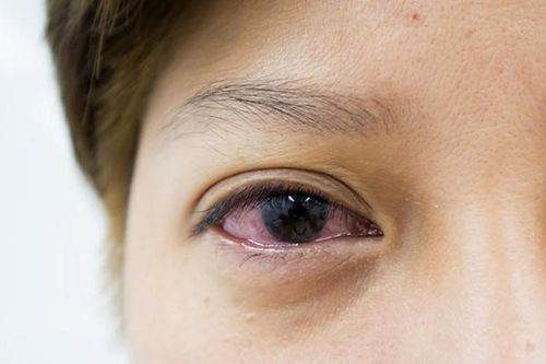 Con có triệu chứng mắt đỏ tưởng bình thường, ai ngờ mắc bệnh hiểm
