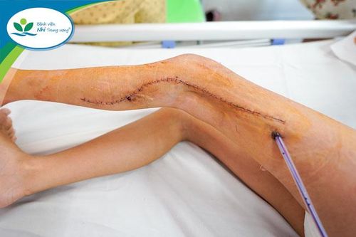 Phục hồi thành công cho bé gái 6 năm không đi lại được do dị dạng tĩnh mạch