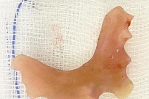 Phát hiện hàm răng giả kẹt trong thực quản nữ bệnh nhân